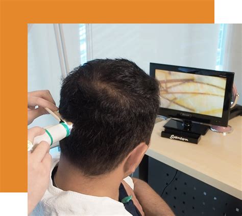 hair transplant cebu|Svenson – Cebu .